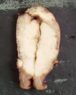 Cancer endometrial cu invazie in peretele uterin pina la nivelul seroasei; col uterin fara invazie macroscopica