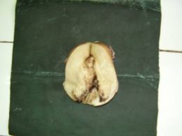 Cancer endometrial (sectiune la nivelul fundului uterului), zona de necroza, aspect macrosopic
