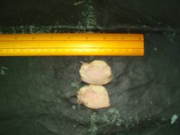 Cancer endometrial: aspect albicios, omogen pe sectiune 