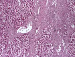 Hepatocarcinom schiros, HE, 4x Hepatocarcinom schiros, HE, 4x