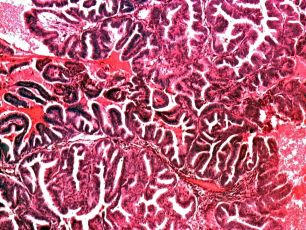 Adenocarcinom papilifer de endometru, HE, 4x 