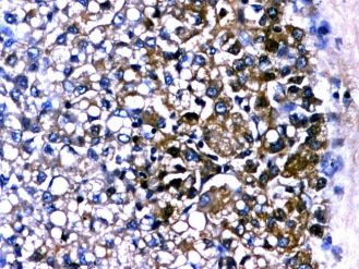 Hepatocarcinom, albumina pozitiva zonal in celulele tumorale, 10x Hepatocarcinom, albumina pozitiva zonal in celulele tumorale, 10x