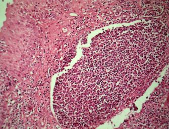 Epiglotita acuta supurativa, cu formare de microabcese, HE, 10x 