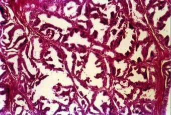 Adenocarcinom papilifer de endometru cu formare de papile secundare si tertiare, HE, 4x 