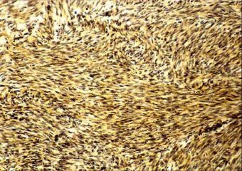 Leiomiofibrom uterin: celule fusiforme cu dispozitie in vartejuri si fascicule, VG, 10x 
