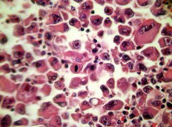 Hepatocarcinom cu celule pleomorfe, HE, 10x Hepatocarcinom cu celule pleomorfe, HE, 10x