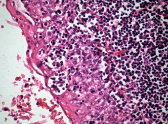 Amigdalita acuta pultcee, cu formare de microabcese intraepiteliale, HE, 20x 