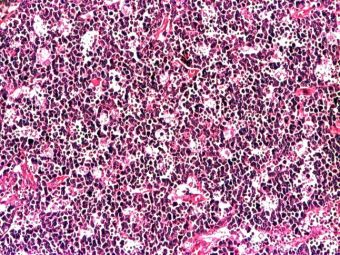 Limfom Burkitt (LMNH limfoblastic), celule de talie medie, macrofage cu corpi tingibili, HE, 10x