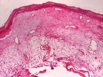 Nodulul cantaretului, tesut conjunctiv lax si mixoid acoperit de epiteliu pavimentos nekeratinizant, HE, 4x 
