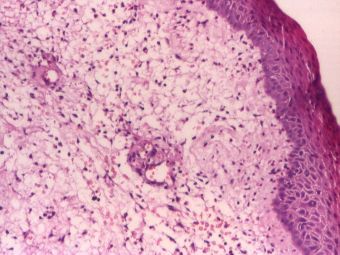 Nodulul cantaretului, acelasi caz, corion cu tesut conjunctiv lax si mixoid cu elemente inflamatorii cronice dispersate, HE, 10x 