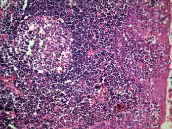 Amigdalita acuta pultacee; infiltrat inflamator cu PMN in grosimea epiteliului scuamos, cu formare de agregate nodulare, asociat cu hiperplazia foliculara reactiva a tesutului limfoid cu formarea de centri germinativi proeminenti, HE, 20x 