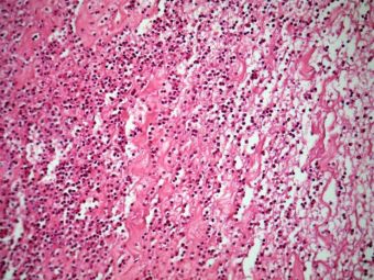 Epiglotita acuta supurativa; acelasi caz, alta zona cu prezenta unui exsudat fibrino-leucocitar abundent la nivelul corionului, HE, 20x 