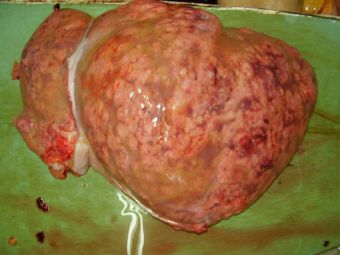 Hepatocarcinom, tipul difuz multinodular in ambii lobi hepatici Hepatocarcinom, tipul difuz multinodular in ambii lobi hepatici