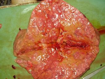 Hepatocarcinom, acelasi caz, sectiune, tipul difuz multinodular Hepatocarcinom, acelasi caz, sectiune, tipul difuz multinodular