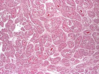 Hepatocarcinom pseudoglandular, HE, 4x Hepatocarcinom pseudoglandular, HE, 4x