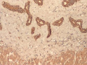 Hamartom de ducte biliare, CK7 pozitiv in ducte biliare, intrahepatice, 4x Hamartom de ducte biliare, CK7 pozitiv in ducte biliare, intrahepatice, 4x