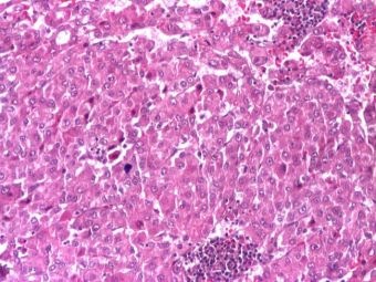Hepatocarcinom cu celule hepatocyte-like, HE, 10x Hepatocarcinom cu celule hepatocyte-like, HE, 10x