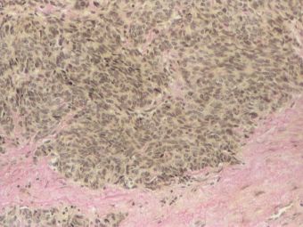Hepatocarcinom cu celule fusiforme, VG, 10x Hepatocarcinom cu celule fusiforme, VG, 10x