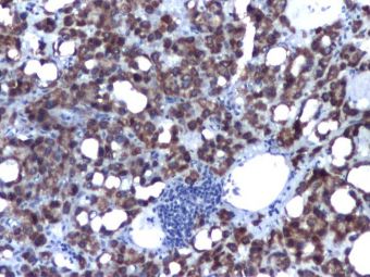 Hepatocarcinom, CK18 pozitiv in celulele tumorale, 10x Hepatocarcinom, CK18 pozitiv in celulele tumorale, 10x