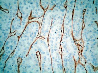 Hepatocarcinom, CD34 pozitiv in vase intratumorale cu pattern sinusoid, 10x Hepatocarcinom, CD34 pozitiv in vase intratumorale cu pattern sinusoid, 10x