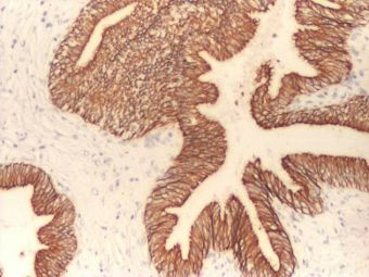 Hamartom de ducte biliare, CK19 pozitiv in ducte biliare intrahepatice, 4x Hamartom de ducte biliare, CK19 pozitiv in ducte biliare intrahepatice, 4x