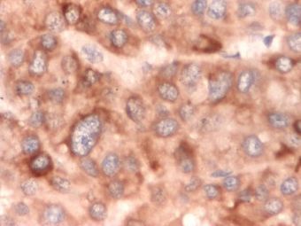 Hepatocarcinom, hibridizare in situ pentru ARNm albuminic in citoplasma celulelor tumorale, 100x, imersie Hepatocarcinom, hibridizare in situ pentru ARNm albuminic in citoplasma celulelor tumorale, 100x, imersie