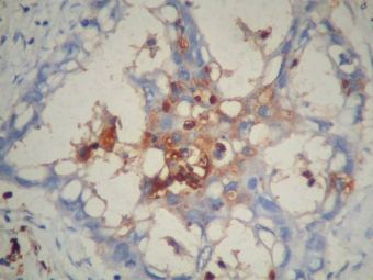 Colangiocarcinom, CEA pozitiv zonal in celulele tumorale, 20x Colangiocarcinom, CEA pozitiv zonal in celulele tumorale, 20x
