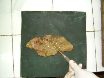 Metastaze hepatice de la un cancer de cap de pancreas Metastaze hepatice de la un cancer de cap de pancreas