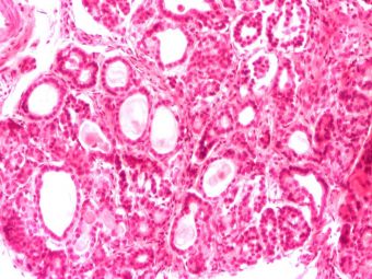 Mucoviscidoza (fibroza chistica a pancreasului), ducte dilatate chistic pline cu un material proteinaceu telescopat, HE, 10x