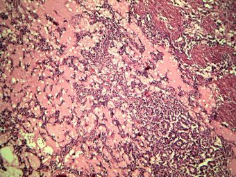 Adenocarcinom mucinos pancreatic (coada pancreasului, metastaze  hepatice prezente, F, 28 ani), HE, 5x