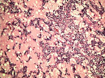 Adenocarcinom mucinos pancreatic, acelasi caz, detaliu, HE, 10x