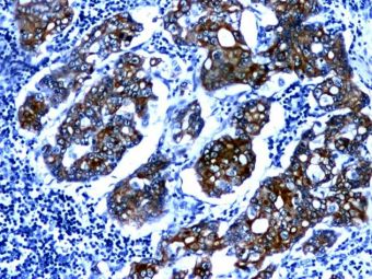 Adenocarcinom pancreatic ductal, KL1 pozitiv in celulele tumorale, 10x