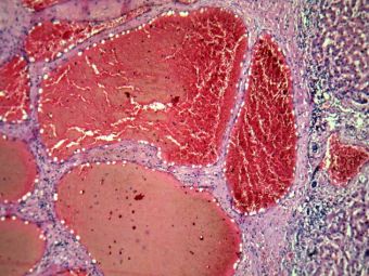 Hemangiom hepatic, acelasi caz, detaliu, cu vase, HE, 10x Hemangiom hepatic, acelasi caz, detaliu, cu vase, HE, 10x