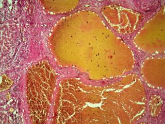 Hemangiom hepatic, acelasi caz, VG, 10x Hemangiom hepatic, acelasi caz, VG, 10x