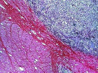 Sarcom stromal endometrial, invazie in miometru, HE, 4x