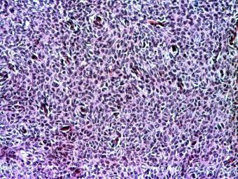 Sarcom stromal endometrial, zona dens celulara cu atipii, HE, 10x 