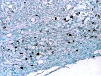 Sarcom stromal endometrial, Ki-67 pozitiv ~ 5-10% in nucleii celulelor tumorale, 20x 