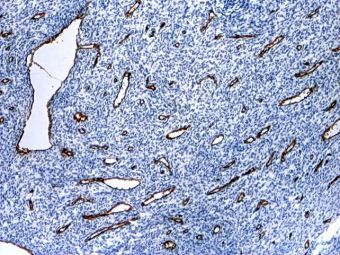 Sarcom stromal endometrial, densitate microvasculara inalta, EGFR pozitiv difuz in numeroase vase capilare intratumorale, 4x 
