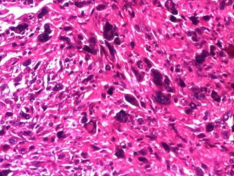 Leiomiosarcom: celule fusiforme si gigante, pleomorfism celular si nuclear, mitoze atipice, HE, 10x 