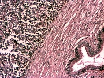 Estesioneuroblastom (neuroblastom olfactiv), HE, 10x 