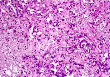 Colangiocarcinom, celule columnare dispuse in tubi cu fibroza si discret mucus, HE, 10x Colangiocarcinom, celule columnare dispuse in tubi cu fibroza si discret mucus, HE, 10x