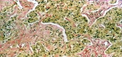 Hepatocarcinom schiros, VG, 4x Hepatocarcinom schiros, VG, 4x